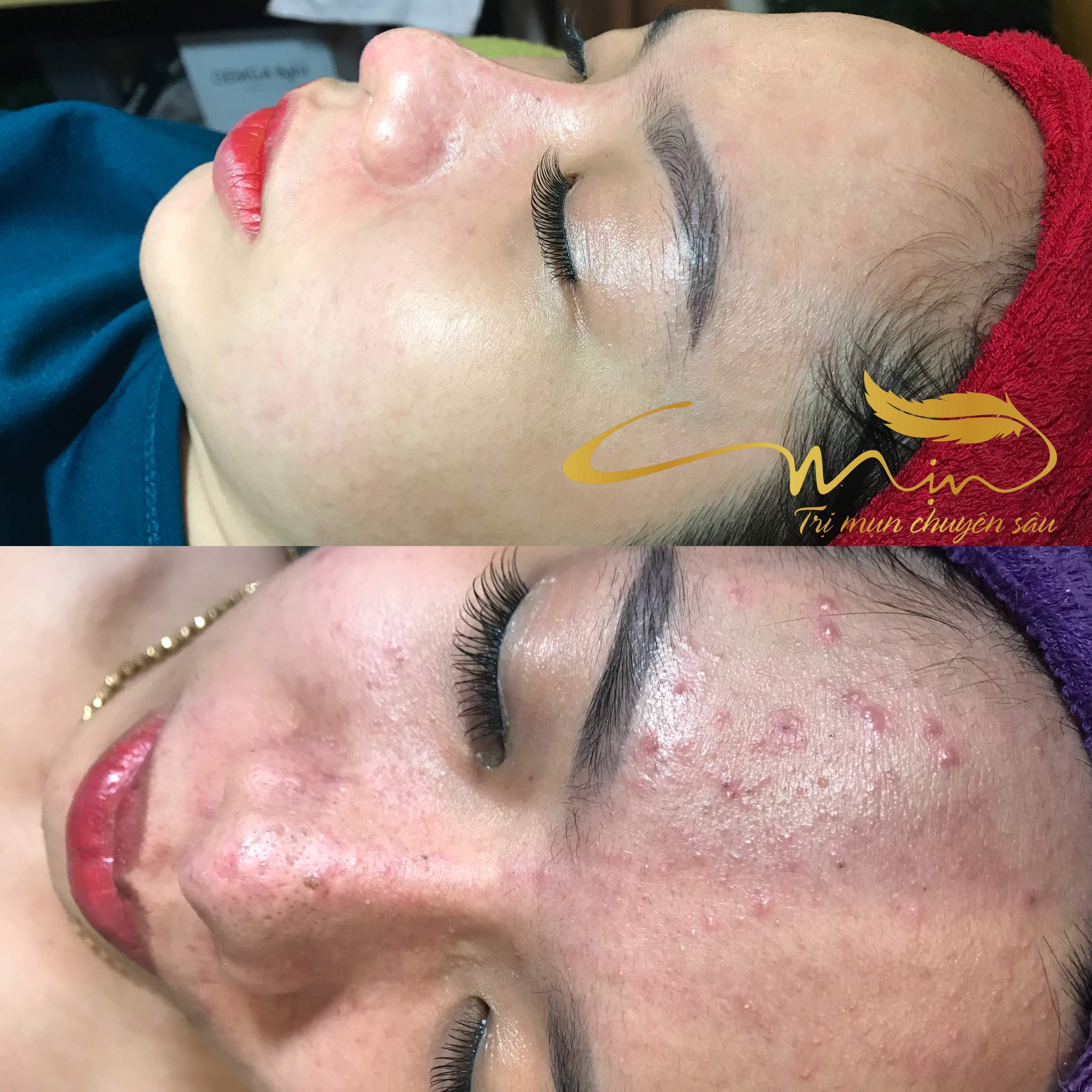 Trị mụn chuyên sâu