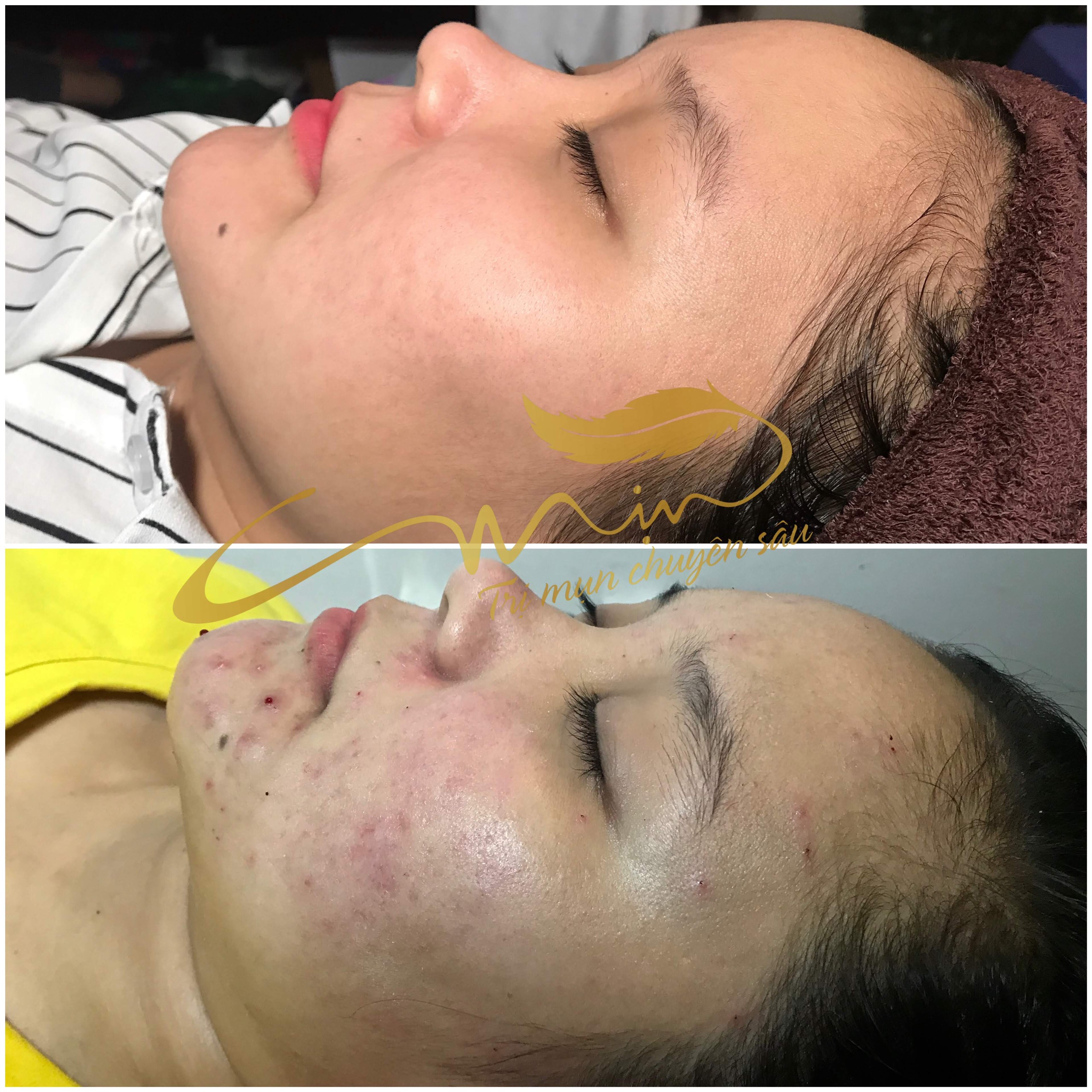 Điều trị mụn nam