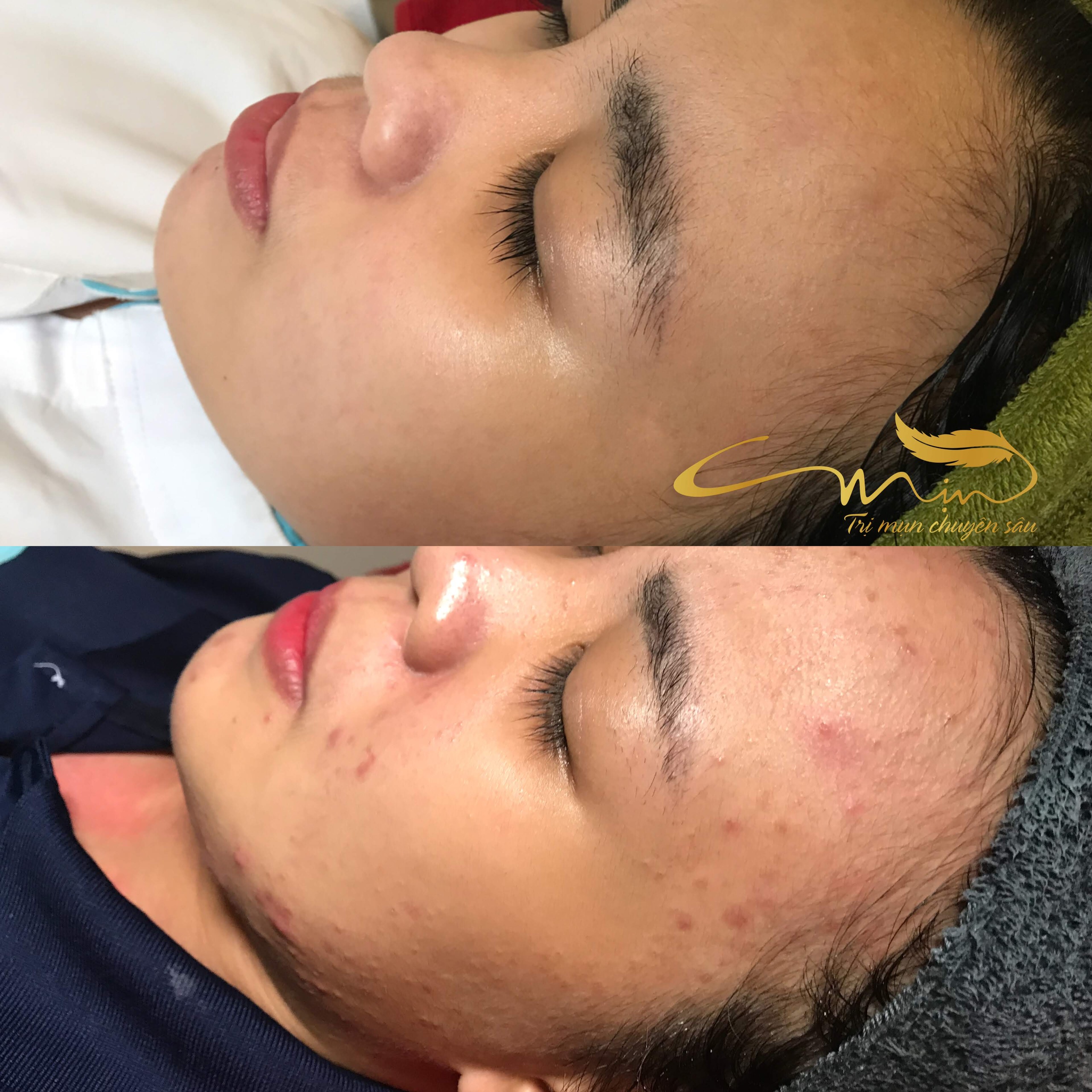 Trẻ hóa da nam
