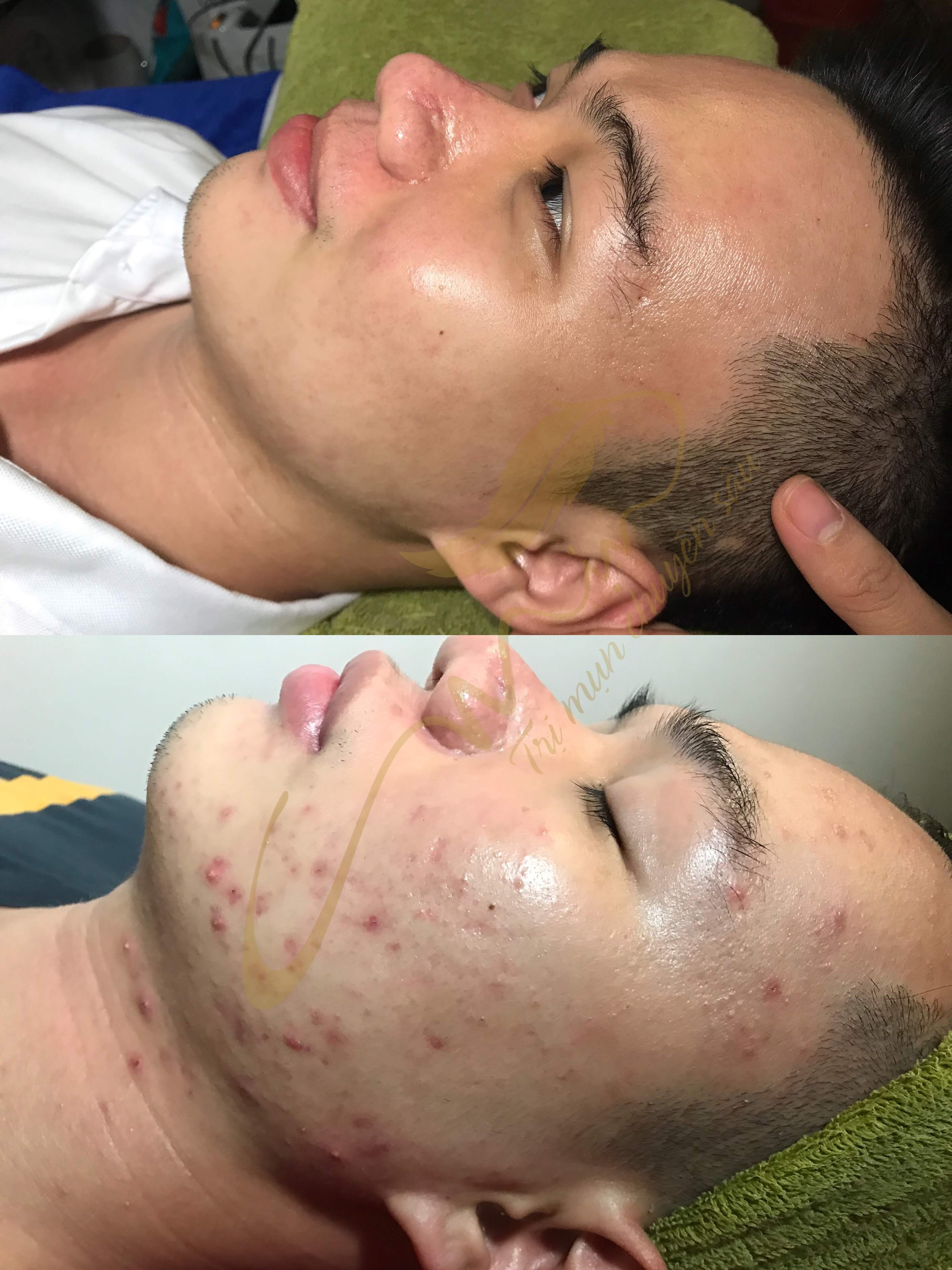 Điều trị mụn viêm
