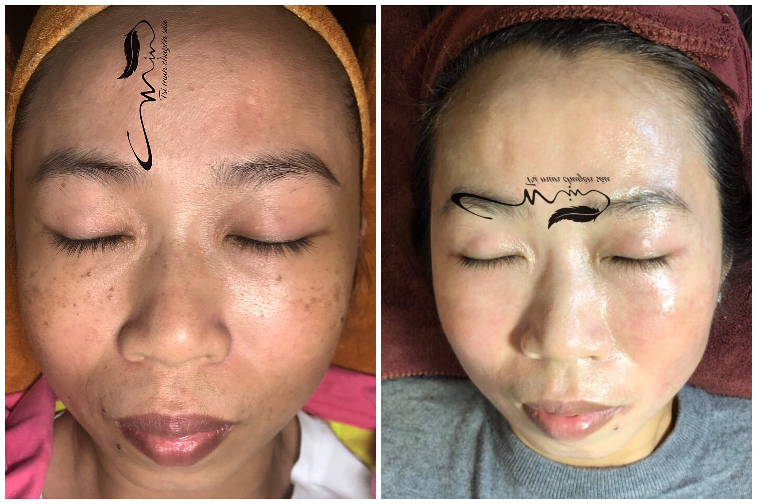 Điều trị nám, tàn nhang