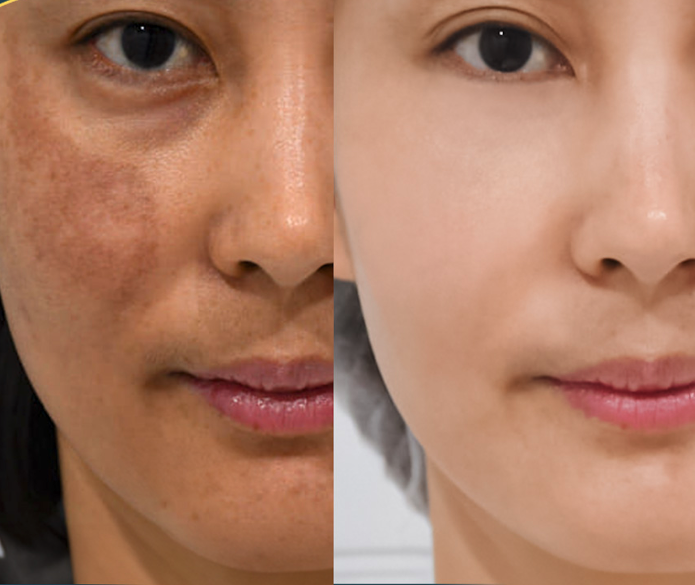 Điều trị nám, tàn nhang